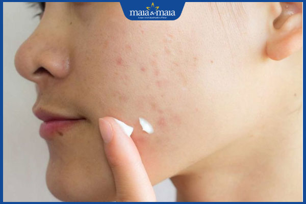 bôi kem trị sẹo thâm