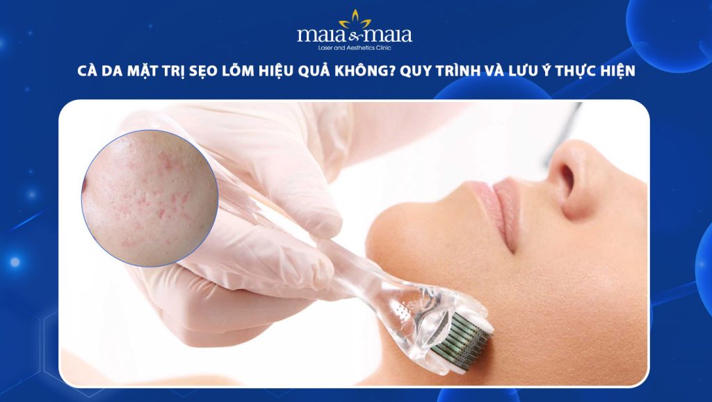 Cà da mặt trị sẹo lõm hiệu quả không? Quy trình và lưu ý thực hiện 1 cà da mặt trị sẹo lõm