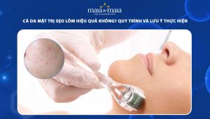 cà da mặt trị sẹo lõm