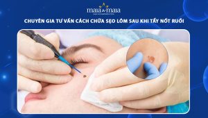 cách chữa sẹo lõm sau khi tẩy nốt ruồi
