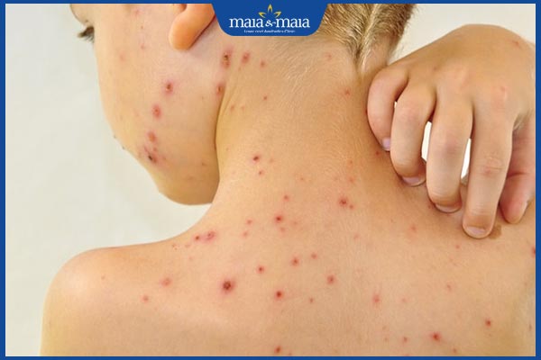 Sẹo lõm thủy đậu do đâu? Phương pháp điều trị hiệu quả 2 cào gãi thủy đậu