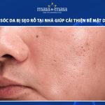 chăm sóc da bị sẹo rỗ