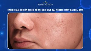 chăm sóc da bị sẹo rỗ