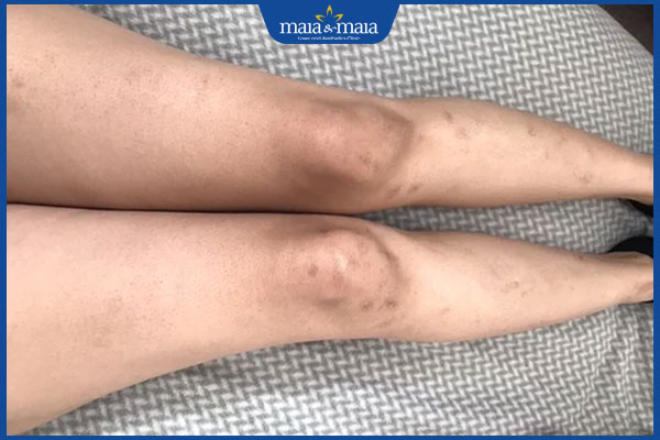 Sẹo thâm khiến da kém sắc: Nguyên nhân và cách xử lý kịp thời 2 chân thâm