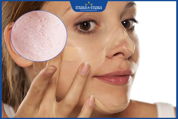 Gợi ý cách trang điểm che sẹo rỗ đơn giản giúp da mịn màng 3 che sẹo rỗ