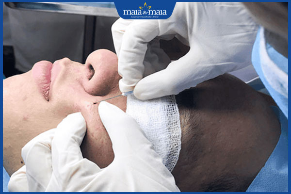 chi phí cắt đáy sẹo