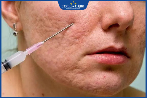 cơ chế cắt đáy sẹo