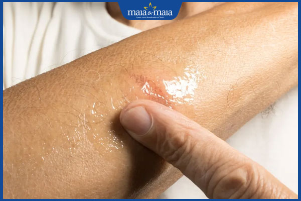 công dụng trị sẹo của mỡ trăn