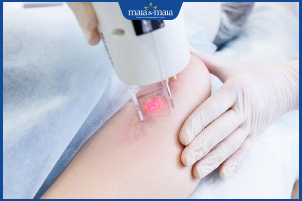 công nghệ trị sẹo lồi ánh sáng vi điểm 3d