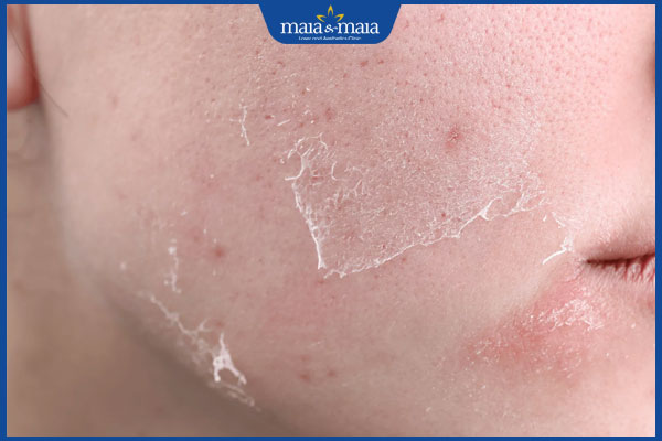 Hướng dẫn chăm sóc da sau điều trị sẹo rỗ đúng chuẩn y khoa 2 da bong vảy