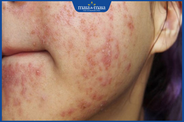 da nổi mụn nước