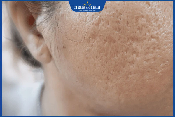 Trị sẹo rỗ bằng laser CO2 có tốt không? Có tác dụng phụ gì? 3 da sẹo khỏe