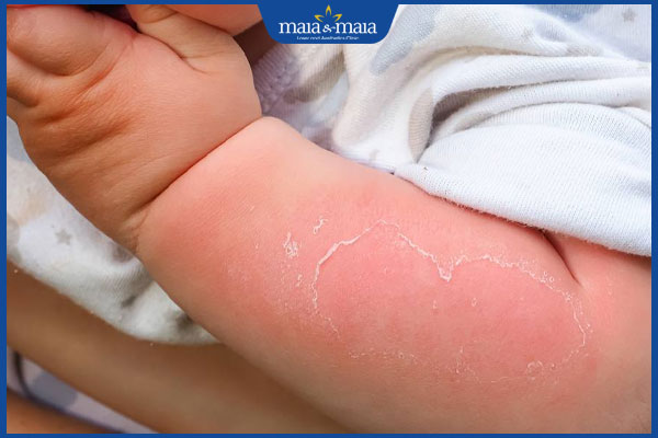 đặc điểm bỏng nước sôi