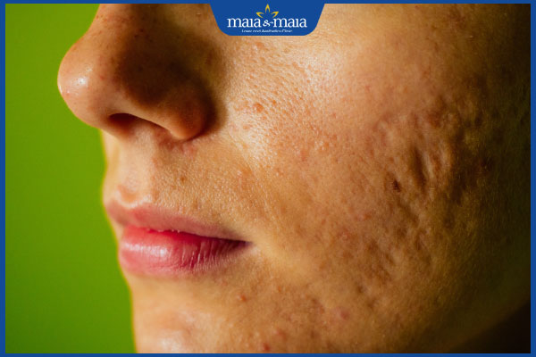 đặc điểm sẹo rỗ đáy tròn