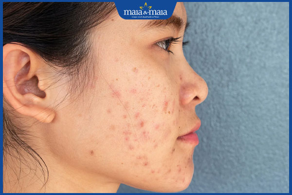 đặc điểm sẹo thâm mụn