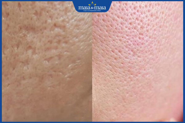 Phân biệt sẹo đáy nhọn và lỗ chân lông to và cách điều trị 2 điểm chung của sẹo đáy nhọn và lỗ chân lông to