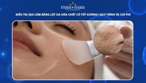 điều trị sẹo lõm bằng lột da hóa chất