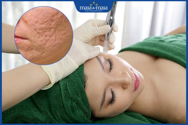 hiệu quả phi kim trị sẹo rỗ