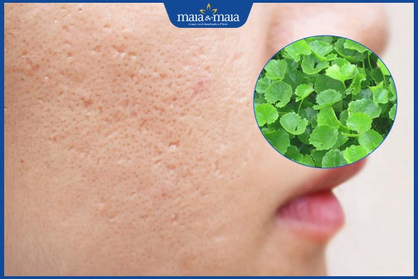 hiệu quả rau má trị sẹo lõm