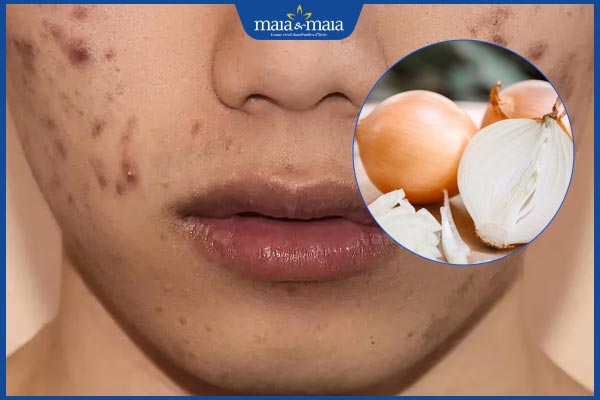 hiệu quả trị thâm của hành tây