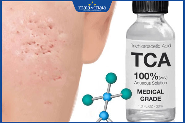 Điều trị sẹo lõm bằng lột da hóa chất có tốt không? 3 hóa chất TCA