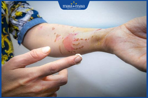 kem bôi trị sẹo bỏng