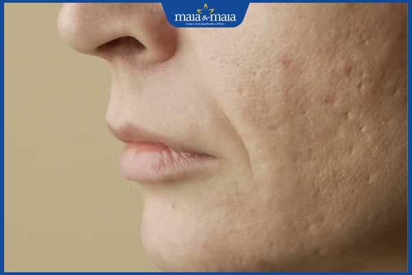 khả năng phục hồi sẹo rỗ đáy tròn