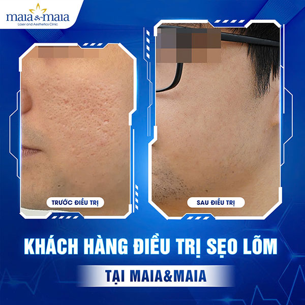 Địa chỉ trị sẹo lõm nào hiệu quả? Những lưu ý khi điều trị 8 khách hàng trị sẹo lõm do mụn