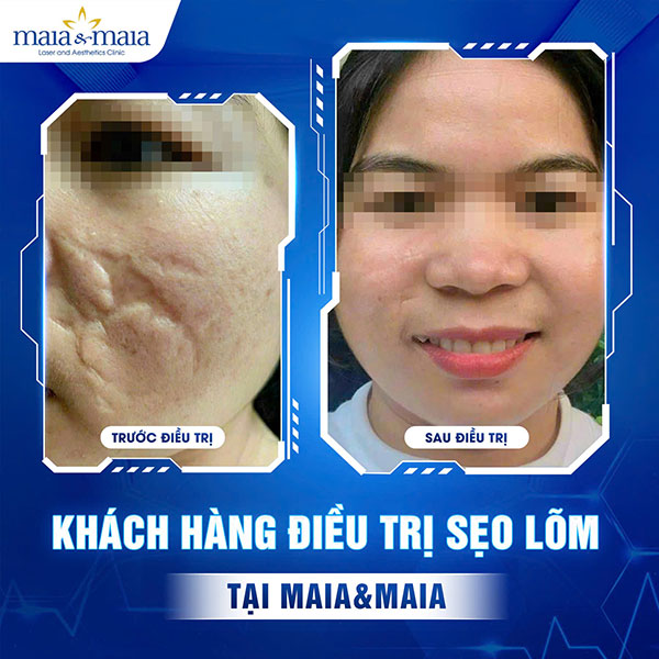 Địa chỉ trị sẹo lõm nào hiệu quả? Những lưu ý khi điều trị 7 khách hàng trị sẹo lõm nặng