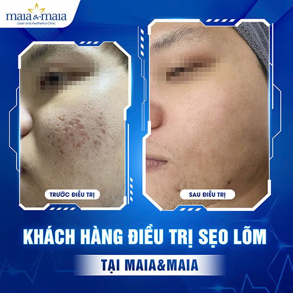 Địa chỉ trị sẹo lõm nào hiệu quả? Những lưu ý khi điều trị 6 khách hàng trị sẹo lõm nhẹ