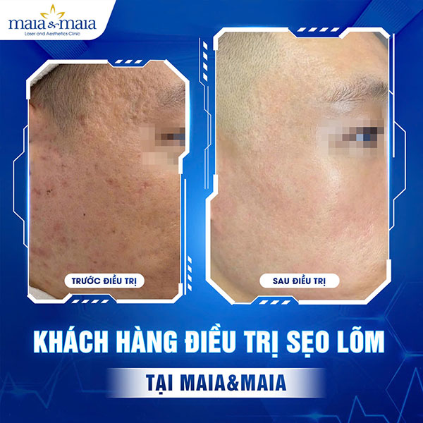 Địa chỉ trị sẹo lõm nào hiệu quả? Những lưu ý khi điều trị 9 khách hàng trị sẹo lõm thâm