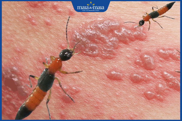 kiến ba khoang đốt