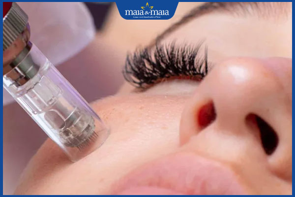 Phân biệt sẹo đáy nhọn và lỗ chân lông to và cách điều trị 3 lăn kim trị sẹo rỗ