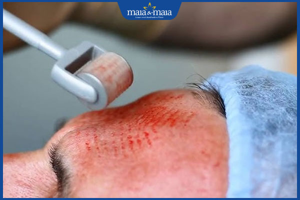 lăn kim trị sẹo