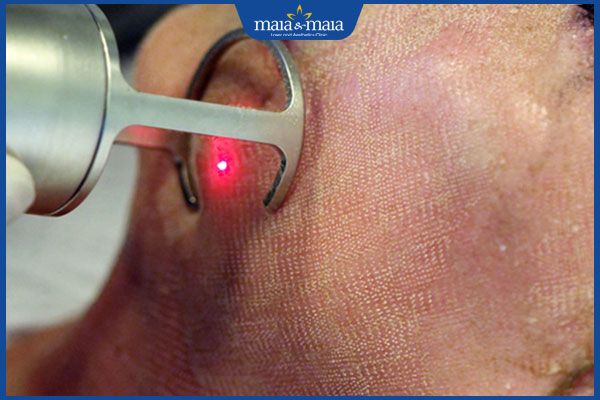 Trị sẹo rỗ bằng laser CO2 có tốt không? Có tác dụng phụ gì? 2 laser co2 xóa sẹo