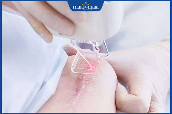 laser trị sẹo bỏng