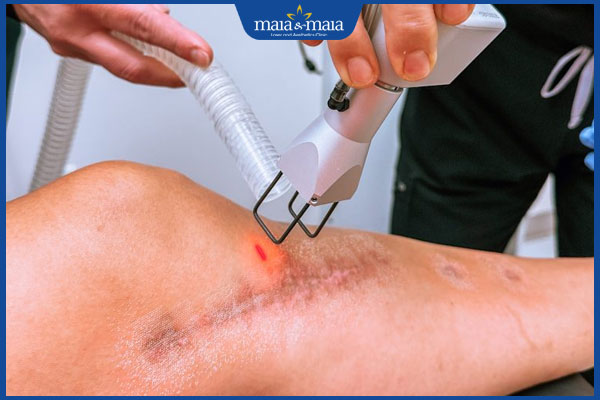 Xóa sẹo thâm ở chân bao nhiêu tiền là hợp lý? Bảng giá chi tiết và địa chỉ uy tín 2 laser xoá sẹo chân