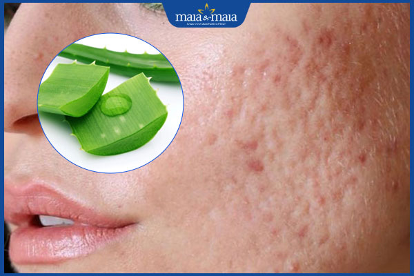 lưu ý trị sẹo rỗ bằng nha đam