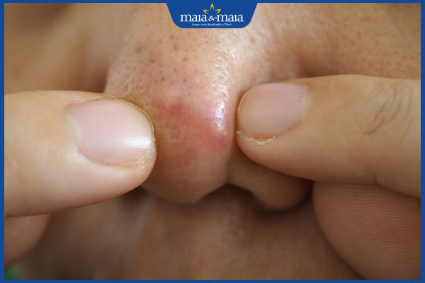 nặn mụn viêm ở mũi