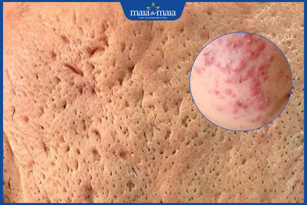 nguyên nhân sẹo đáy nhọn