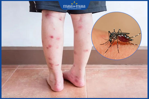 nguyên nhân sẹo thâm chân