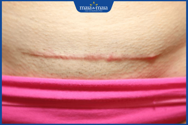 nhận biết sẹo lồi do mổ đẻ