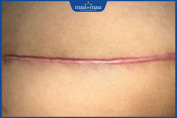 nhận biết sẹo phì đại