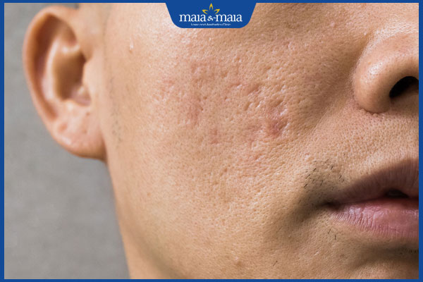 Cách nhận dạng sẹo rỗ đáy vuông và phác đồ điều trị dứt điểm 2 nhận biết sẹo rỗ đáy vuông