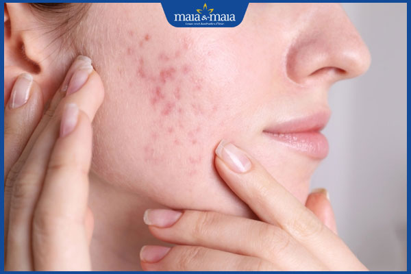 nhận dạng sẹo lõm mới hình thành