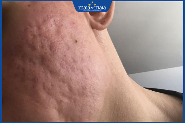 nhận diện sẹo rỗ lượn sóng