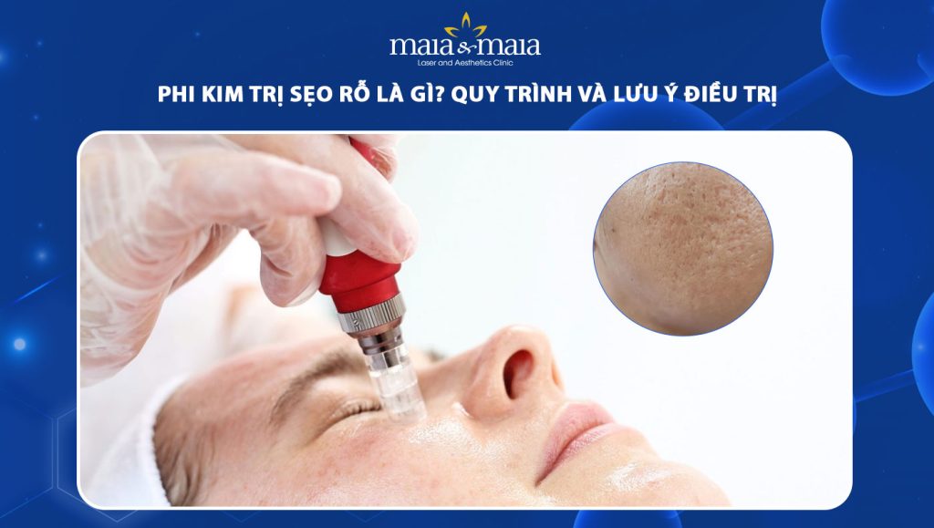 phi kim trị sẹo rỗ