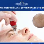 phi kim trị sẹo rỗ