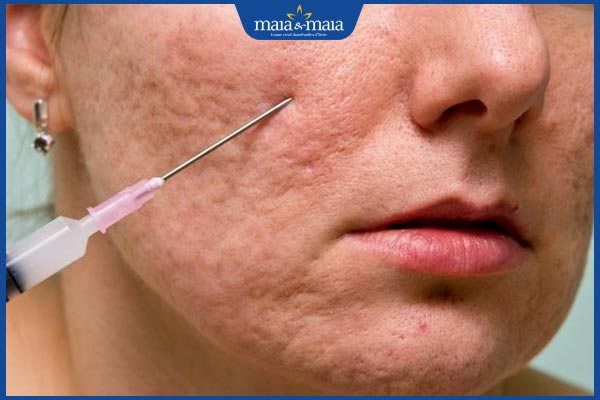 phương pháp cắt đáy sẹo