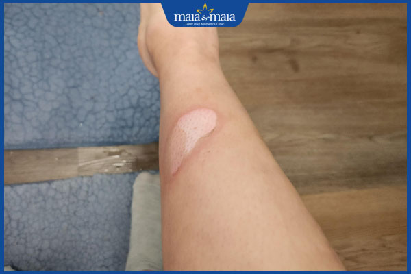 sẹo bỏng đang lên da non